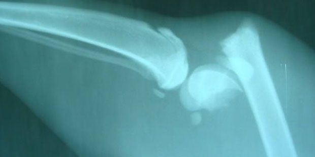 同种异体骨骨折临床及预防的进展